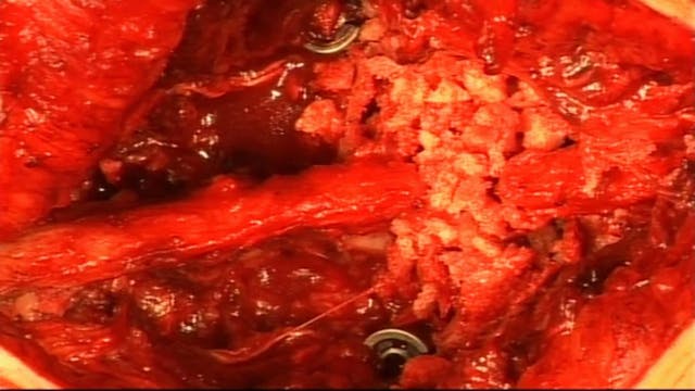 Degenerative lumbar disease - transfo...