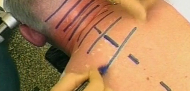 Correction and stabilization in ankylosing spondylitis of cervicothoracic spine