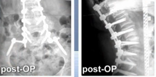 Posterior spinal instrumented fusion and decompression