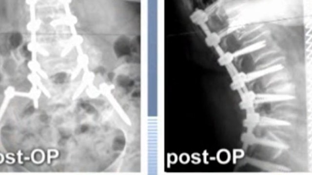 Posterior spinal instrumented fusion and decompression