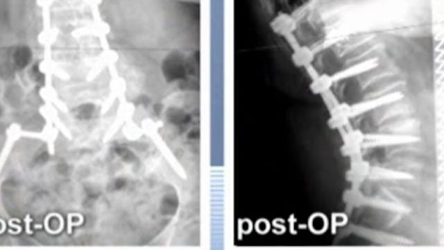 Posterior spinal instrumented fusion ...