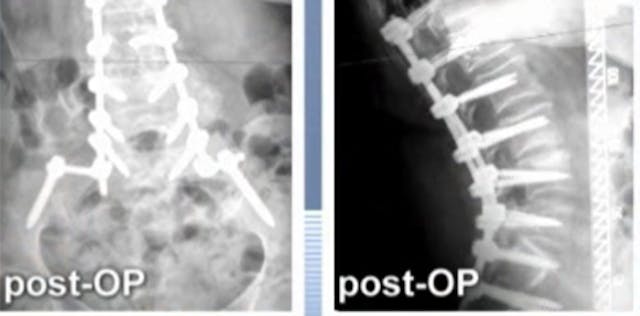 Posterior spinal instrumented fusion ...