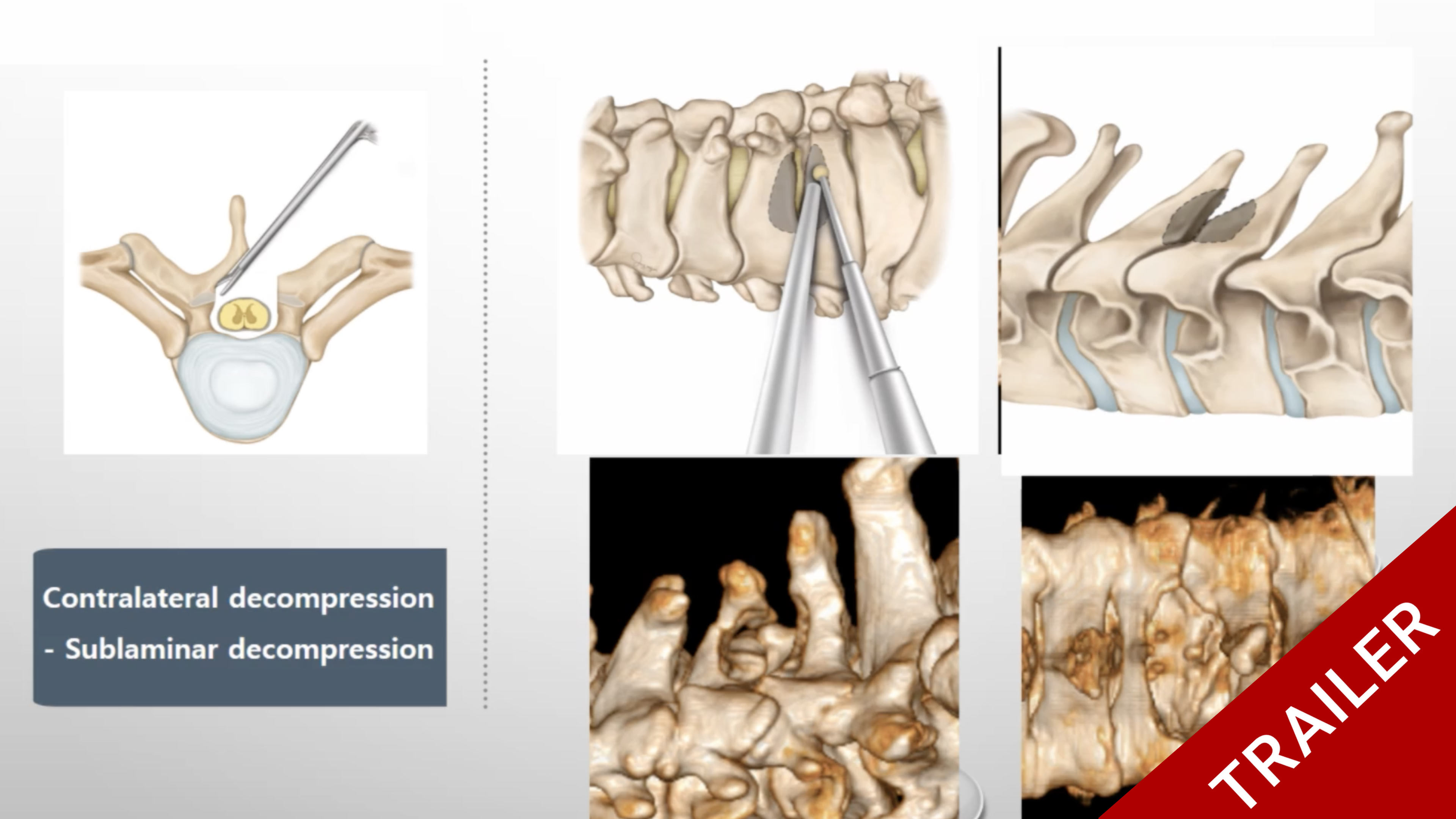 Trailer Posterior cervical laminectomy by unilateral biportal endoscopy