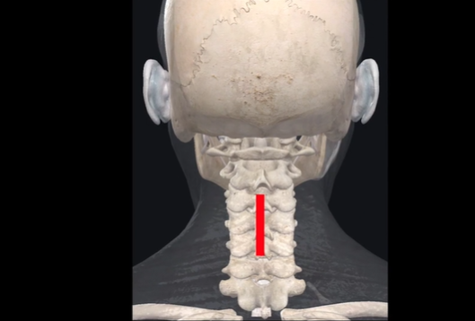 Open surgical reduction of pediatric C4-C5 dislocation with unilateral ...