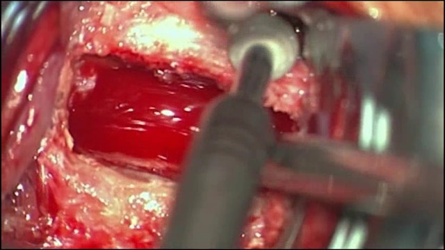 Anterior cervical discectomy and implantation of an artificial disc