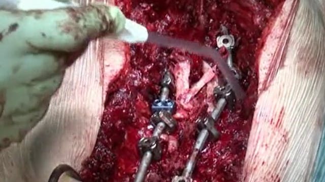 Pedicle subtraction osteotomy in flat...