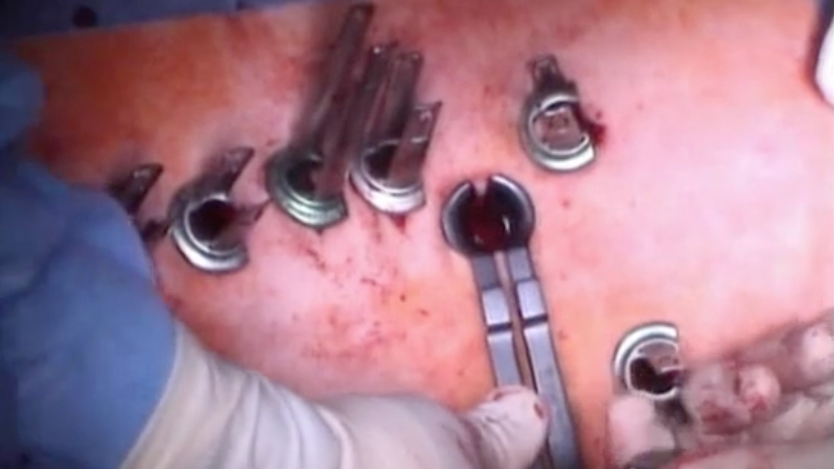 Trailer Percutaneous multilevel reconstruction in revision surgery