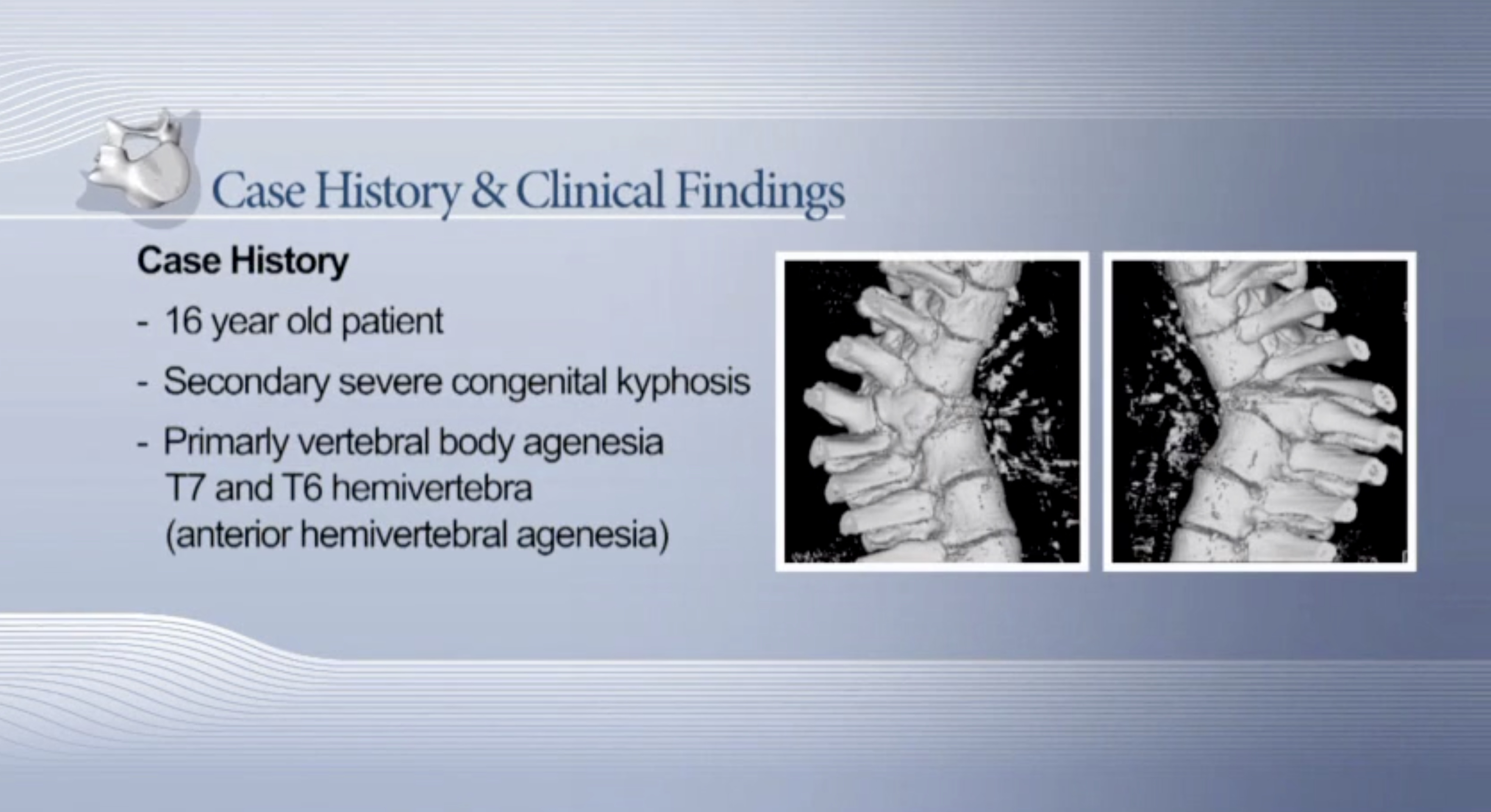 Trailer Paraplegia after posterior only correction of congenital kyphosis