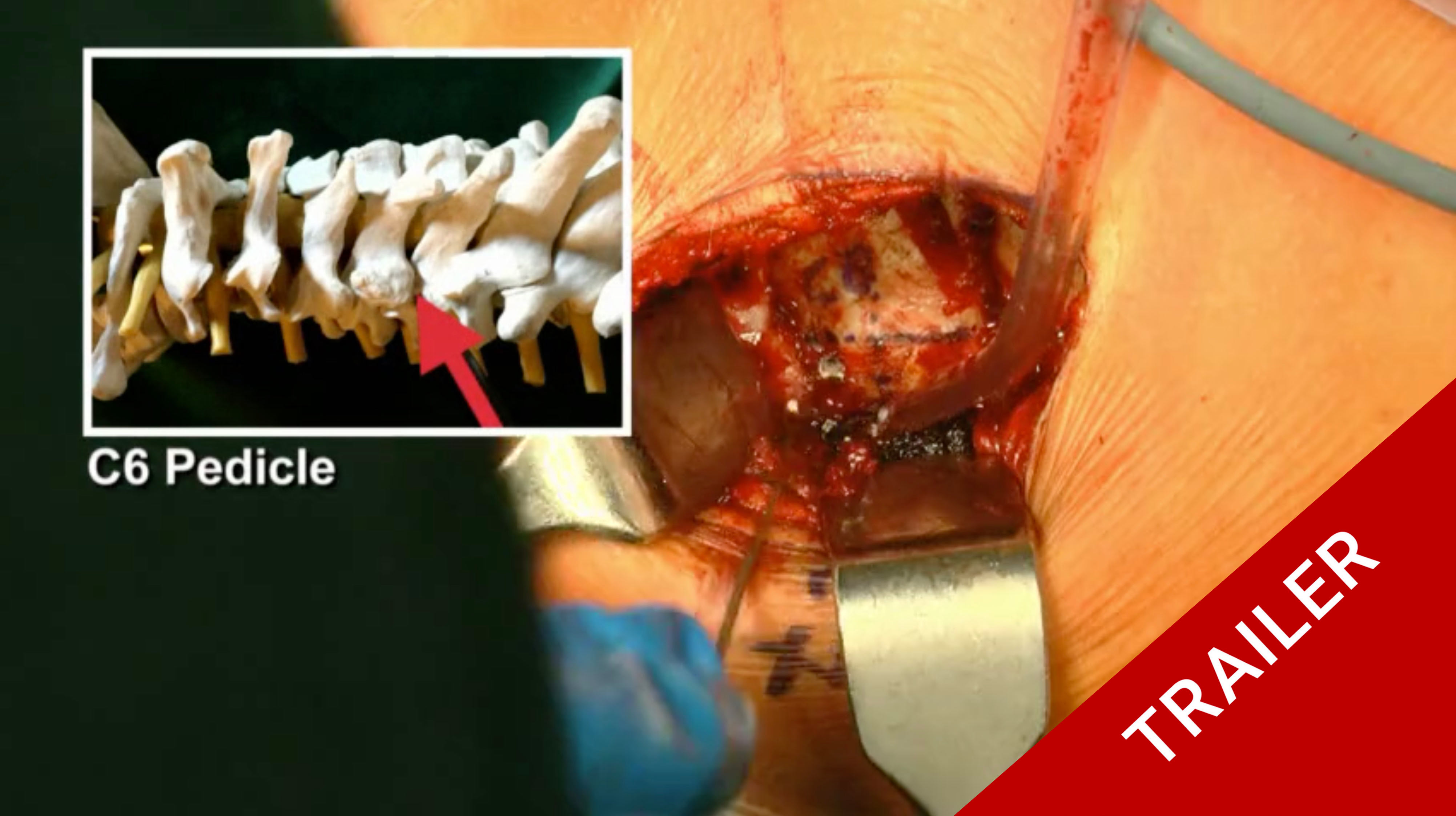 Trailer Anterior cervical decompression and 360° fusion with posterior ...