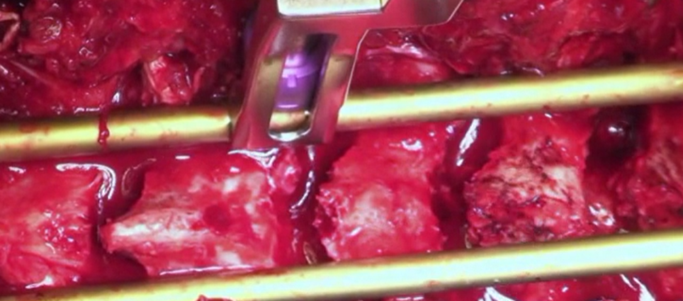 Correction of post-traumatic hyperkyphosis by multiple Chevron osteotomies