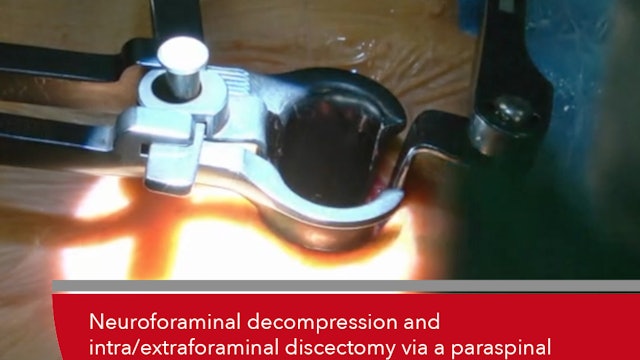 Teaser Neuroforaminal decompression and intra/extraforaminal discectomy