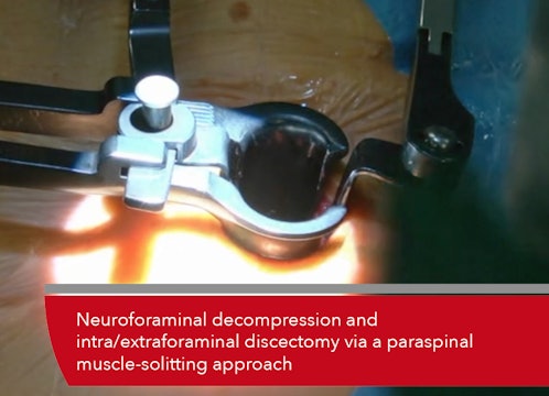 Teaser Neuroforaminal decompression and intra/extraforaminal discectomy