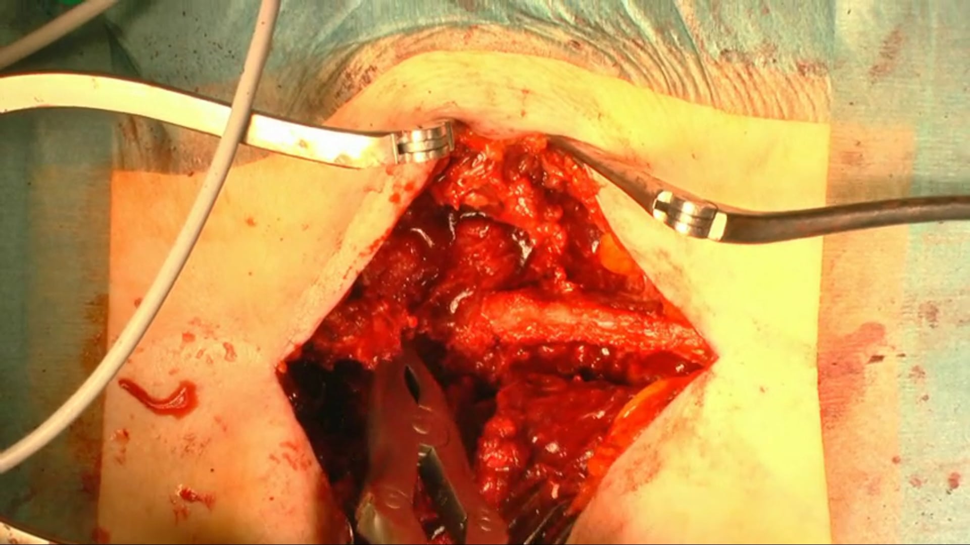 Fracture stabilization L3-S1, PLIF L5-S1 with decompression