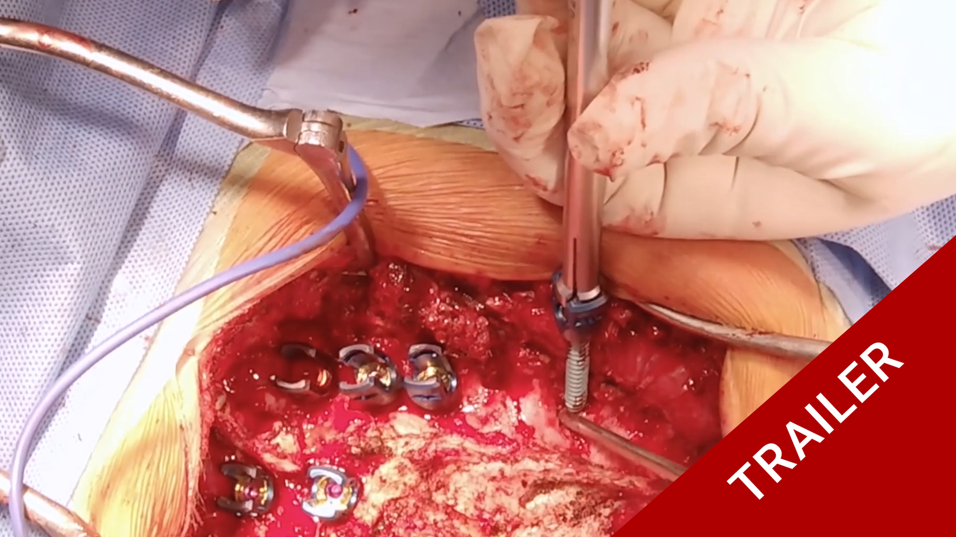 Trailer Congenital Thoracic Scoliosis