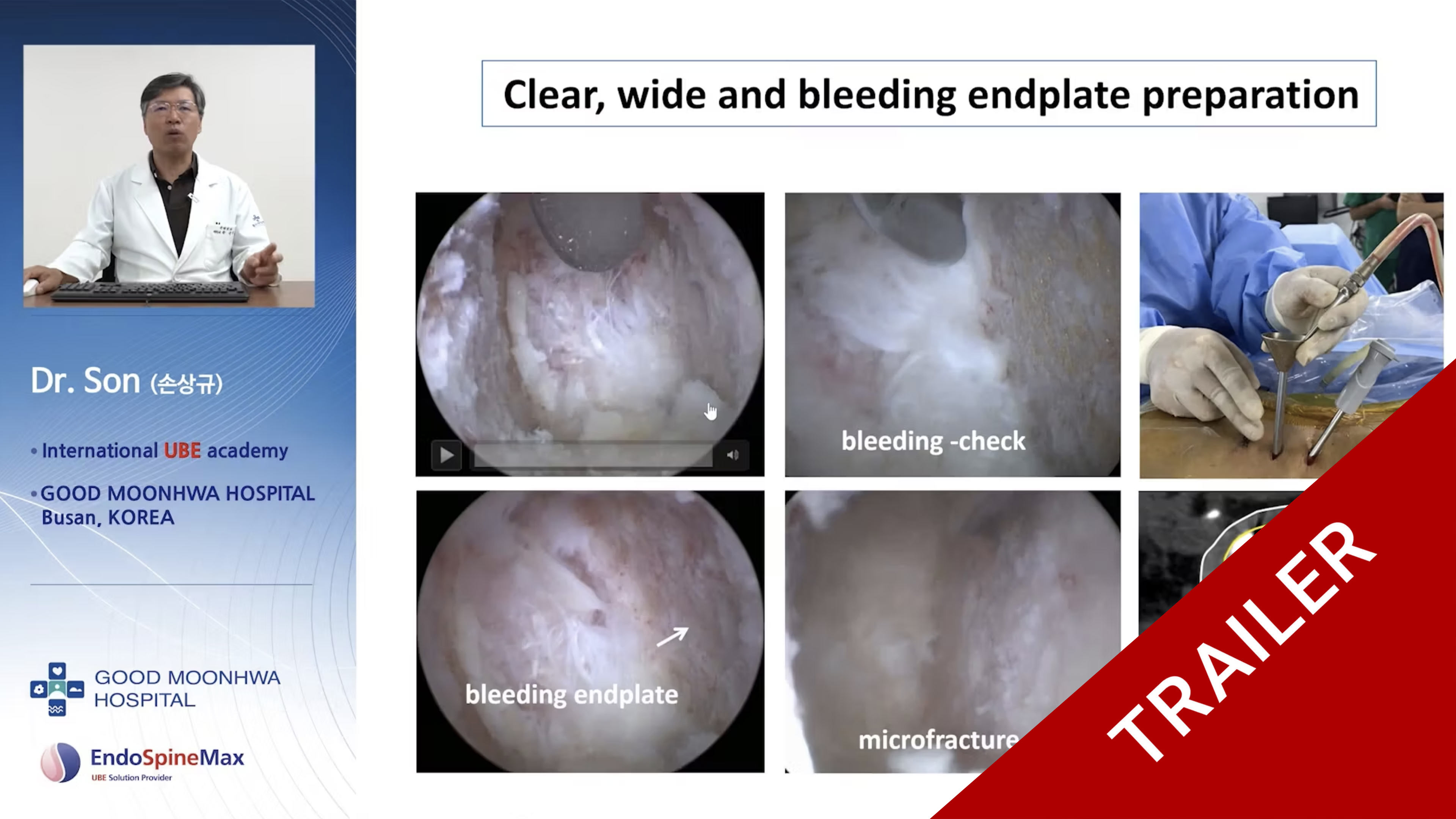 Trailer UBE lumbar interbody fusion, ULIF