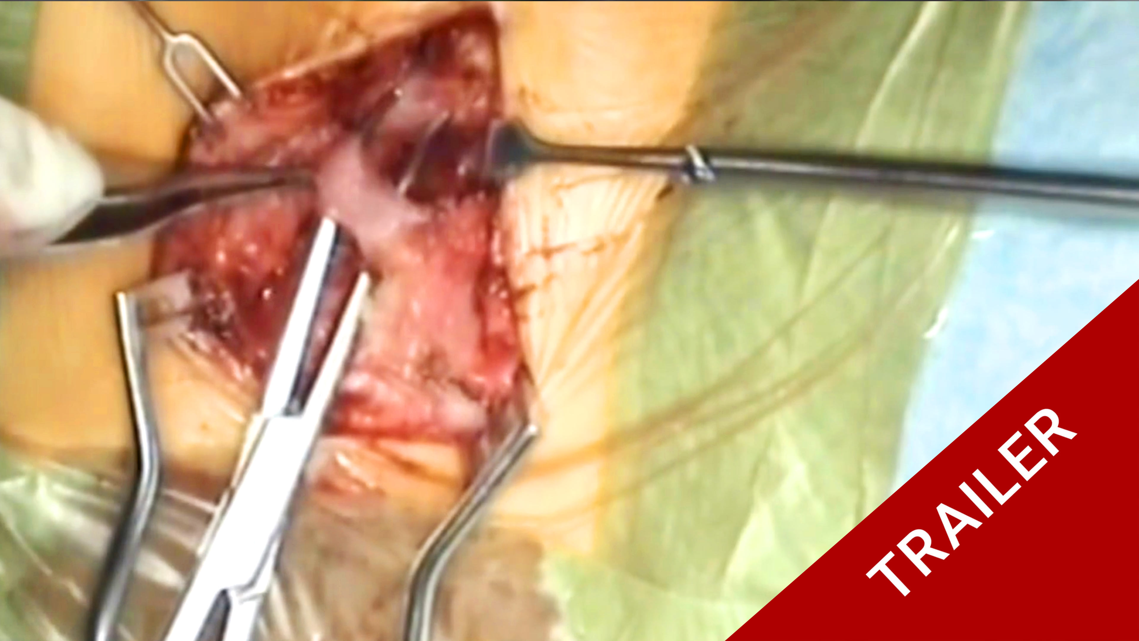 Trailer Masterclass 5.3 Klippel-Feil of the cervico-thoracic junction