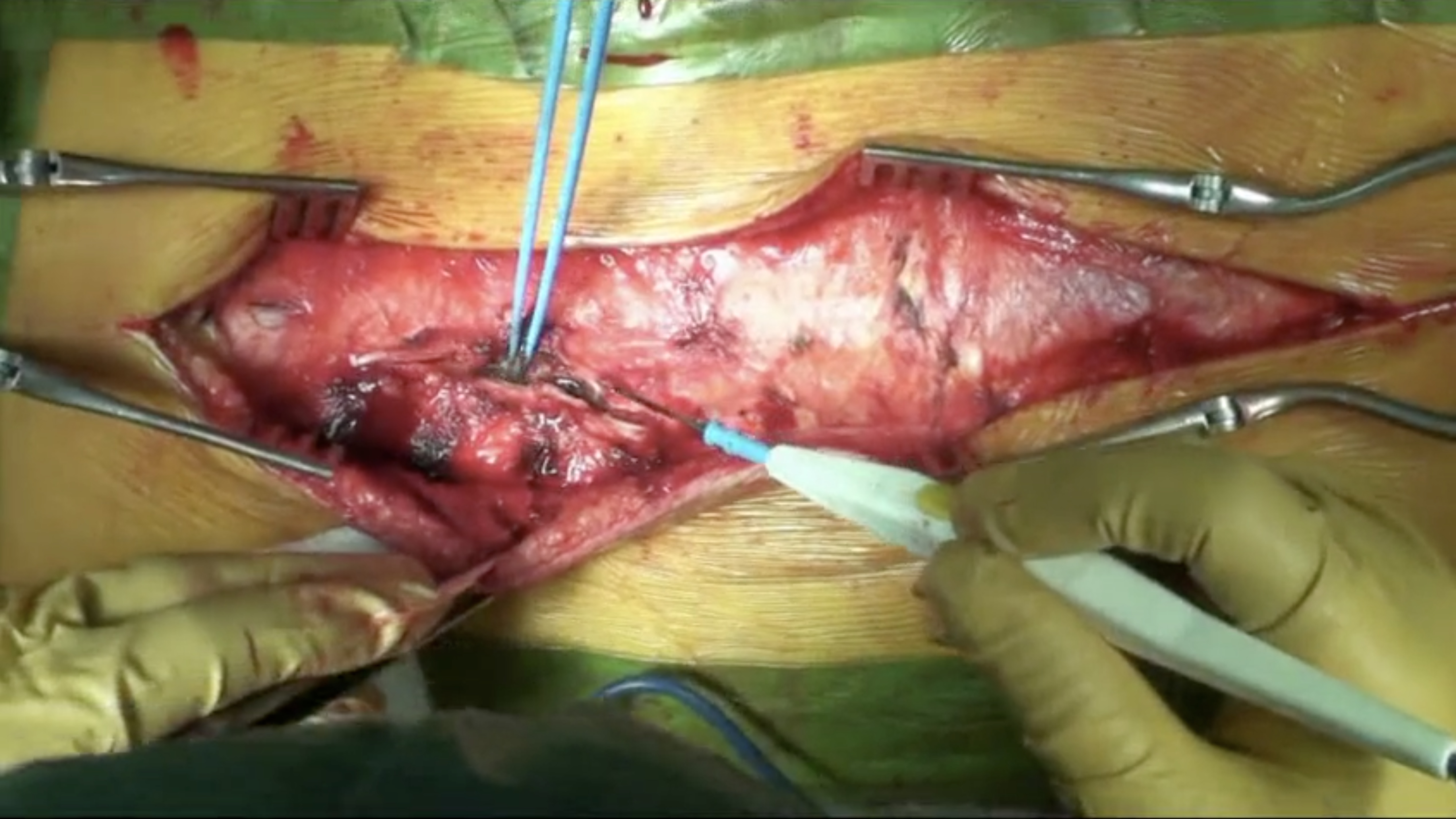 Trailer Hybrid strategy for correction and T3 sacrum posterior fusion...