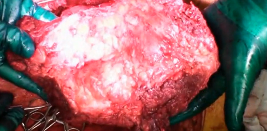 Chordoma of the sacrum en bloc high partial sacretomy