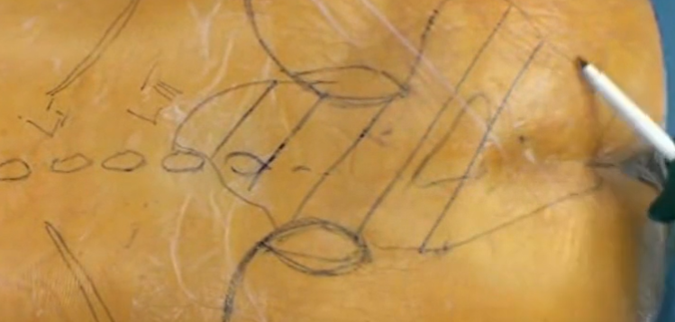 Chordoma of the sacrum en bloc total sacretomy and lumbopelvic reconstruction