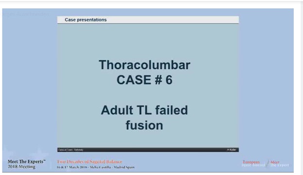 Adult TL failed fusion; case presentations