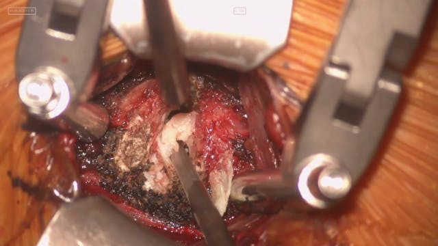 Anterior decompression and fixation w...