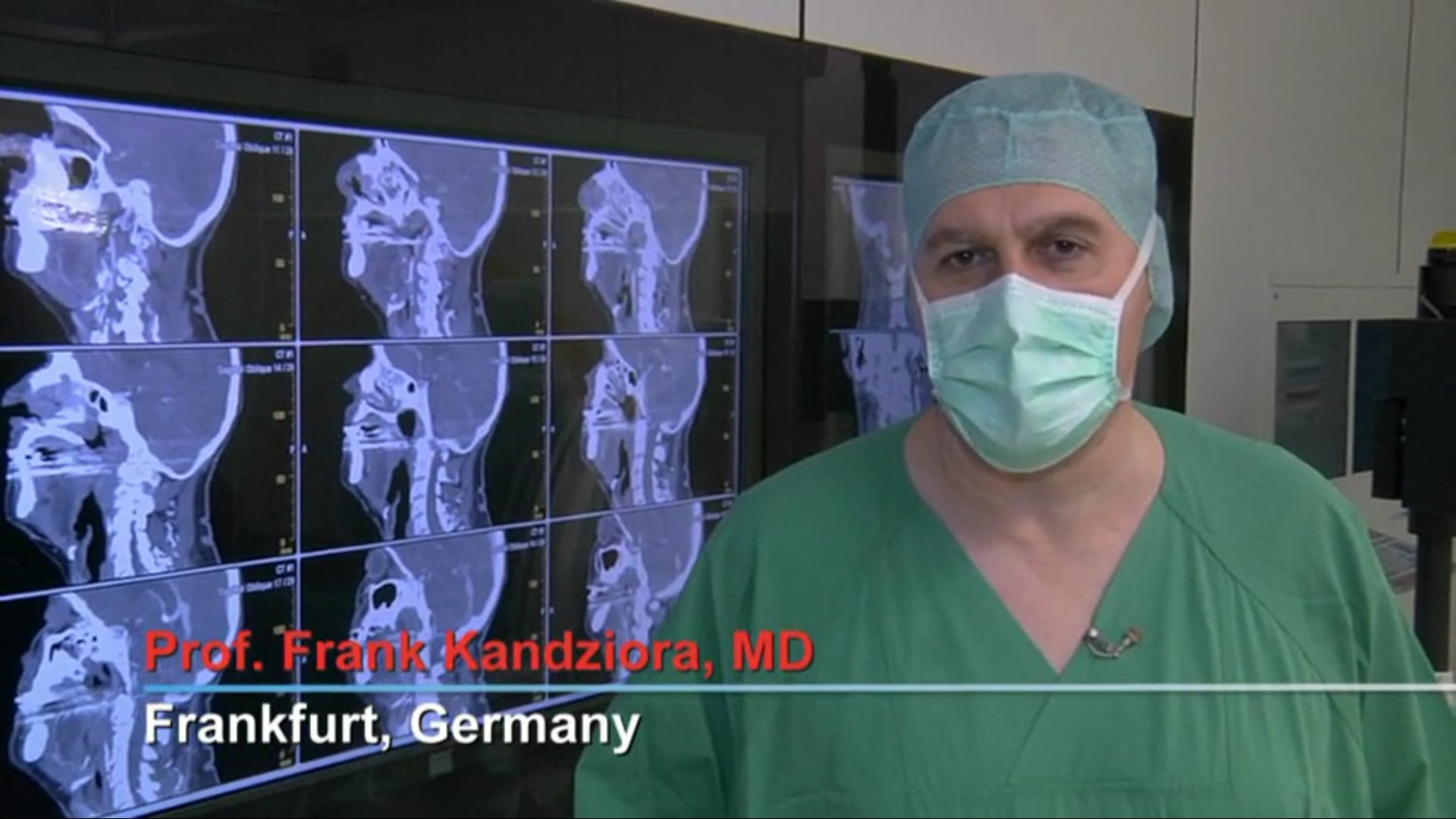 Atypical C2 fracture treated by posterior atlantoaxial fusion according to .....