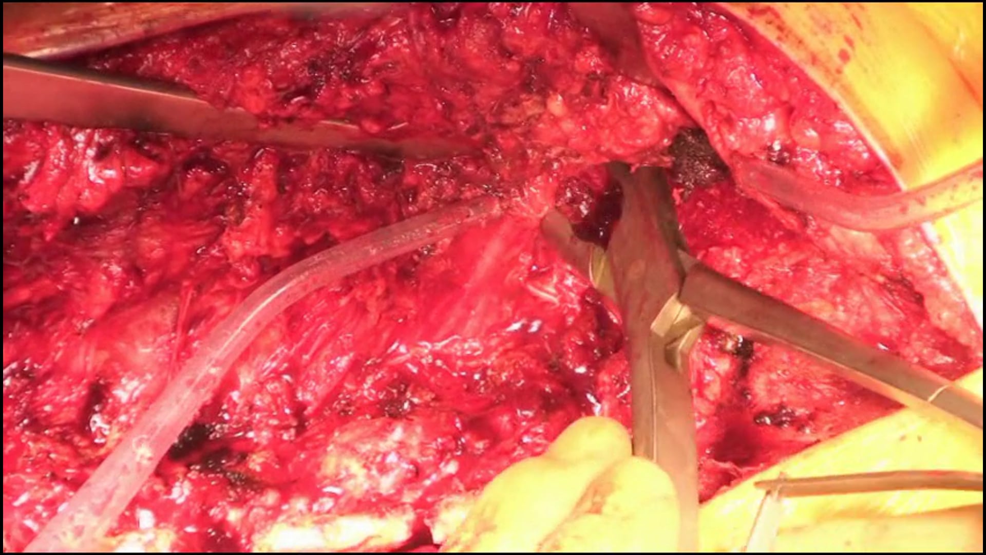 360° release and in situ bending correction for sagittal imbalance, part 2