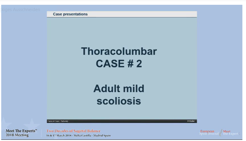 Adult mild scoliosis; case presentations