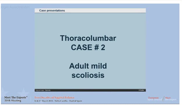 Adult mild scoliosis; case presentations