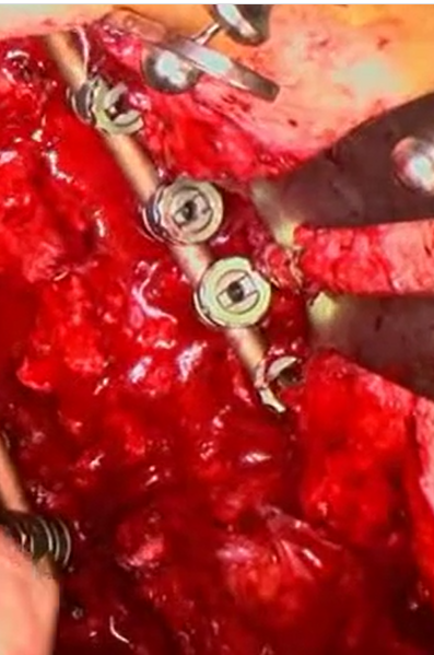 Revision and stabilization surgery of an adult degenerative scoliosis