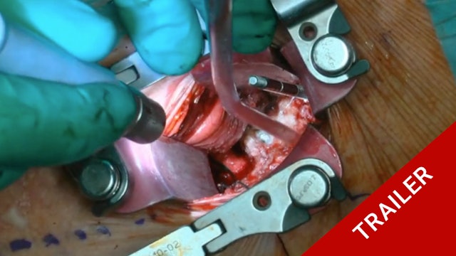Trailer Anterior multiple cervical corpectomy and fusion in revision surgery