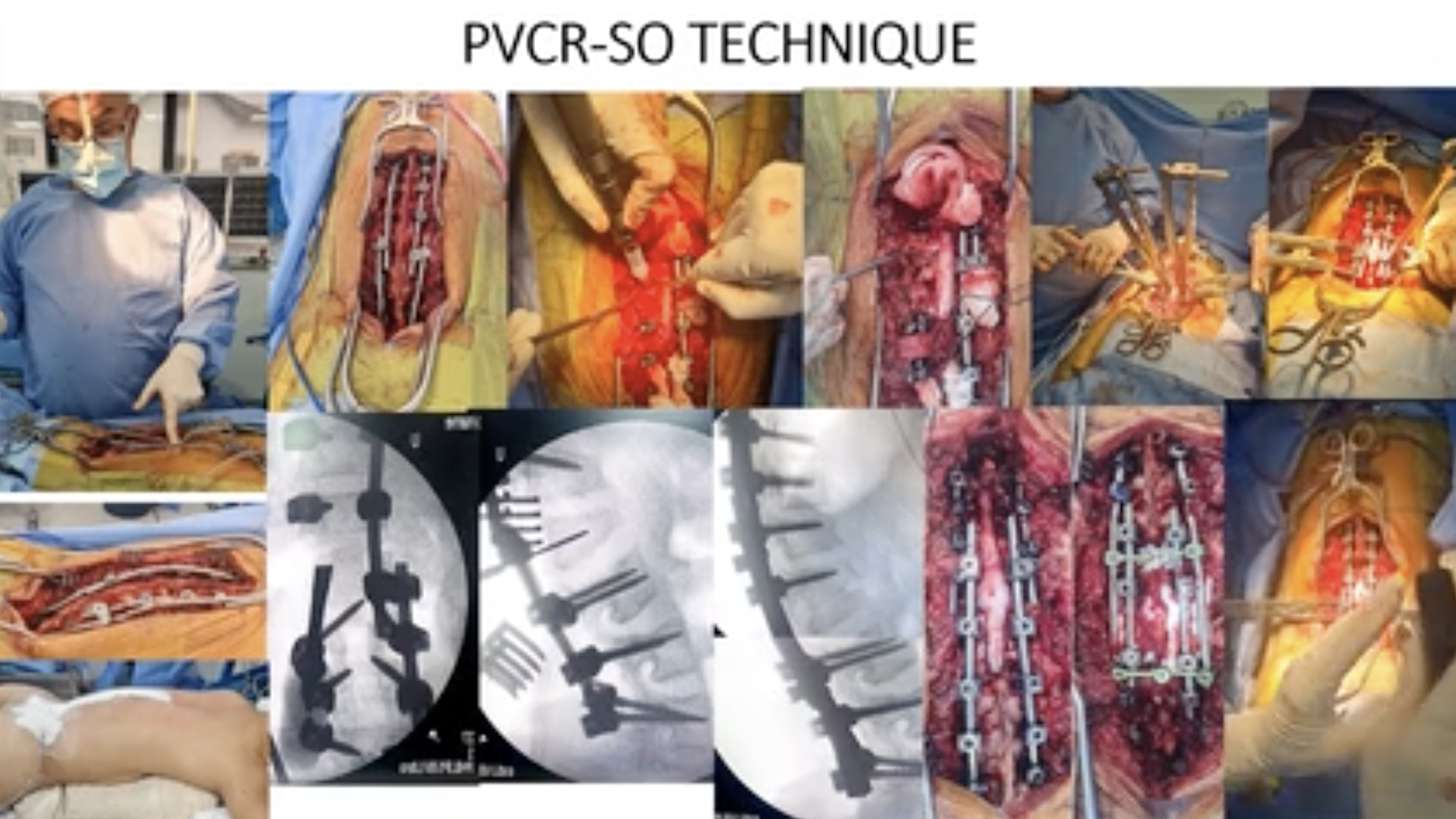 Posterior vertebral column resection (PVCR) in angular kyphosis 