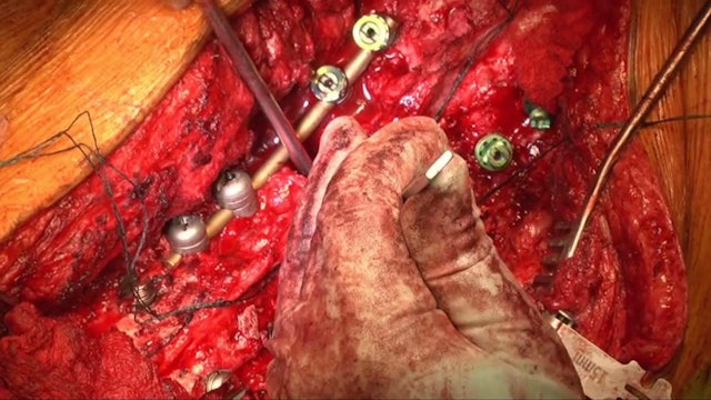 Combined thoracic and lumbar osteotomies for correction of sagittal imbalance