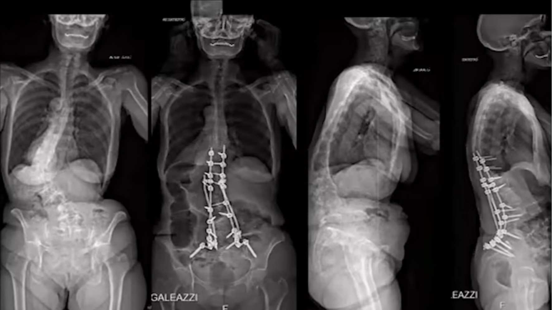 WFNS Spine Committee Webinar 2020: Adult Degenerative Deformity Symposia 2