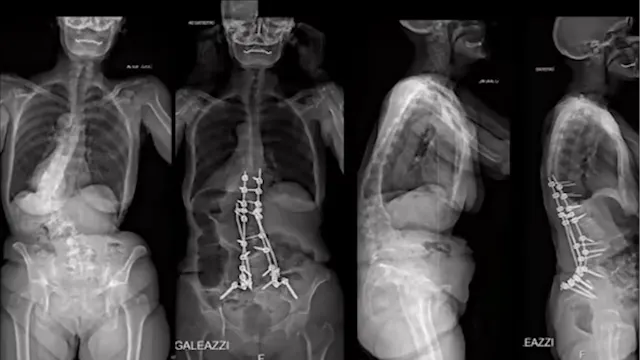 WFNS Spine Committee Webinar 2020: Ad...