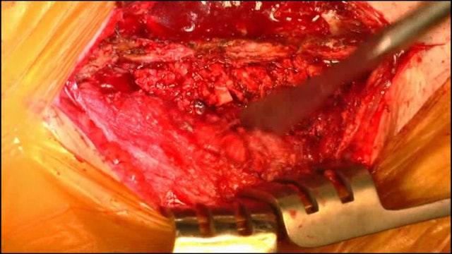Removal of metalwork from the lumbar spine