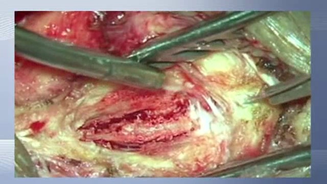 Lumbar spinous process split decompression