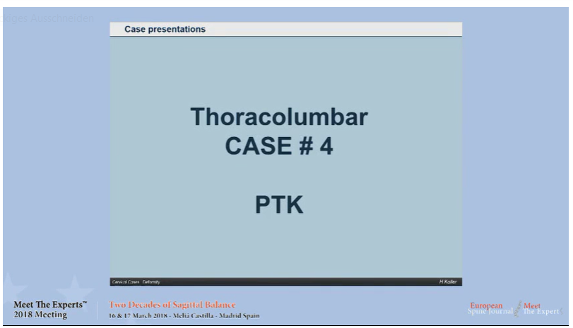 Posttraumatic kyphosis; case presentation