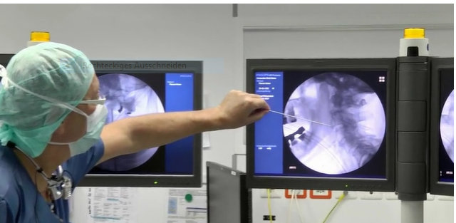 Combined anterior screw fixation of an odontoid fracture and the atlanto-axial..