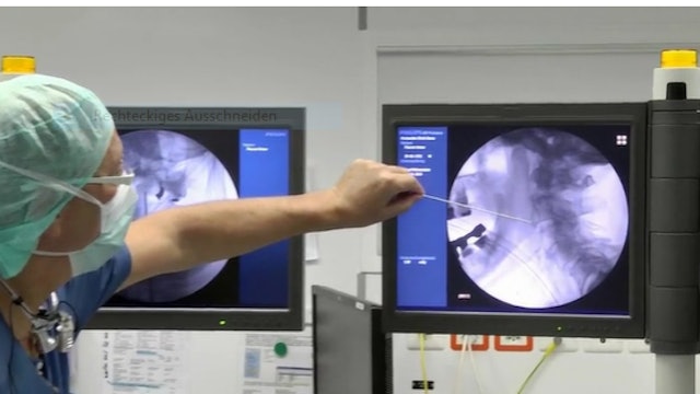 Combined anterior screw fixation of an odontoid fracture and the atlanto-axial..