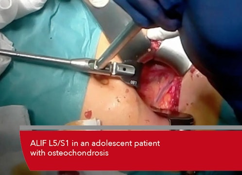 Teaser ALIF L5/S1 in an adolescent patient with osteochondrosis