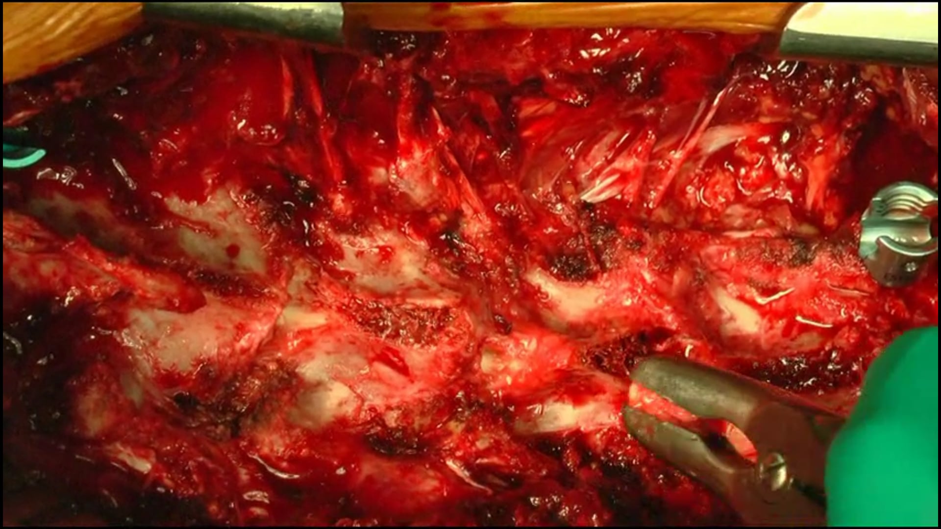 Selective thoracolumbar instrumentation with pedicle screws and sublaminar ...