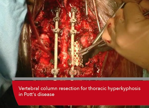 Teaser Vertebral column resection for thoracic hyperkyphosis in Pott's disease