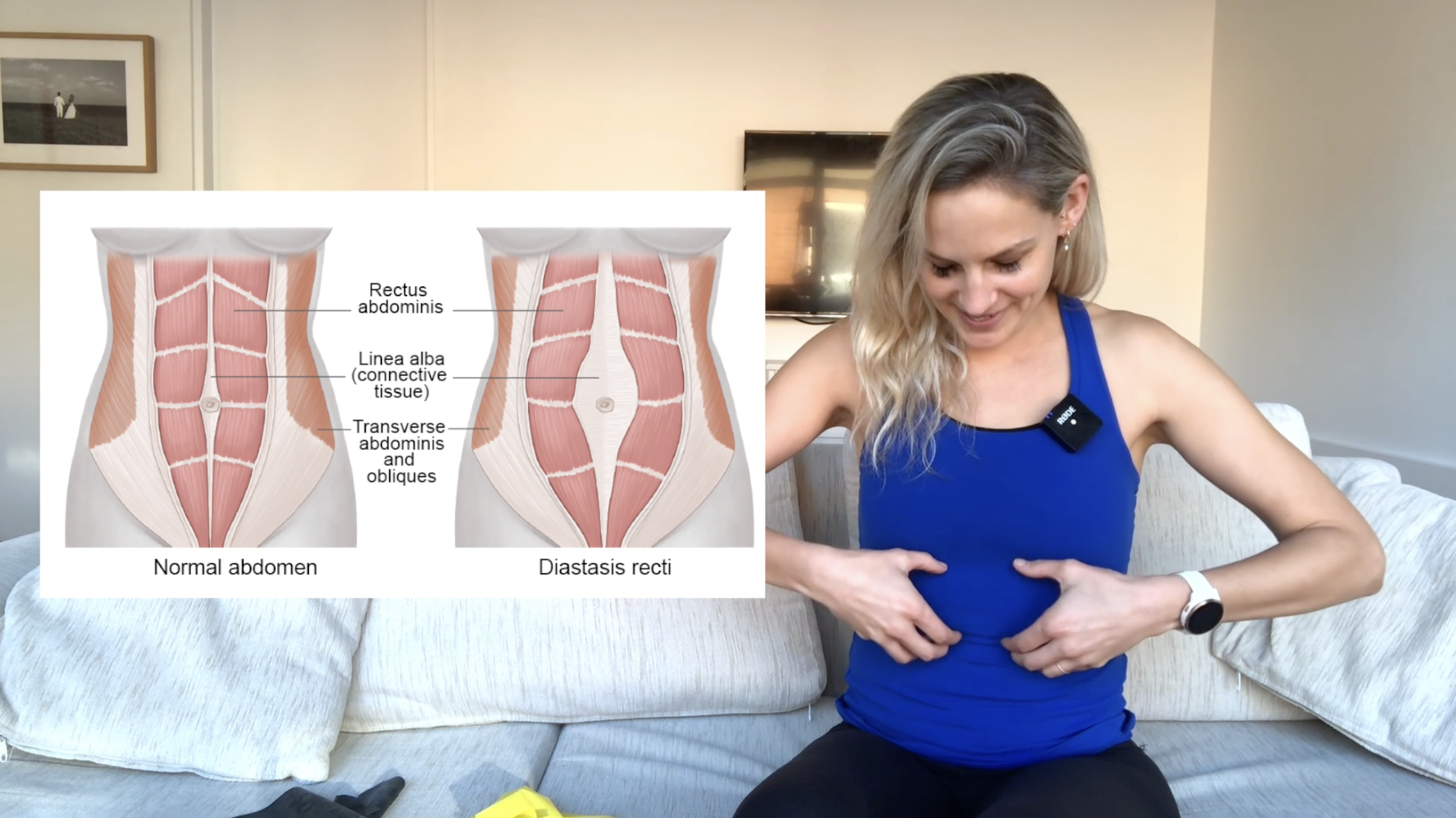 Abdominal Separation