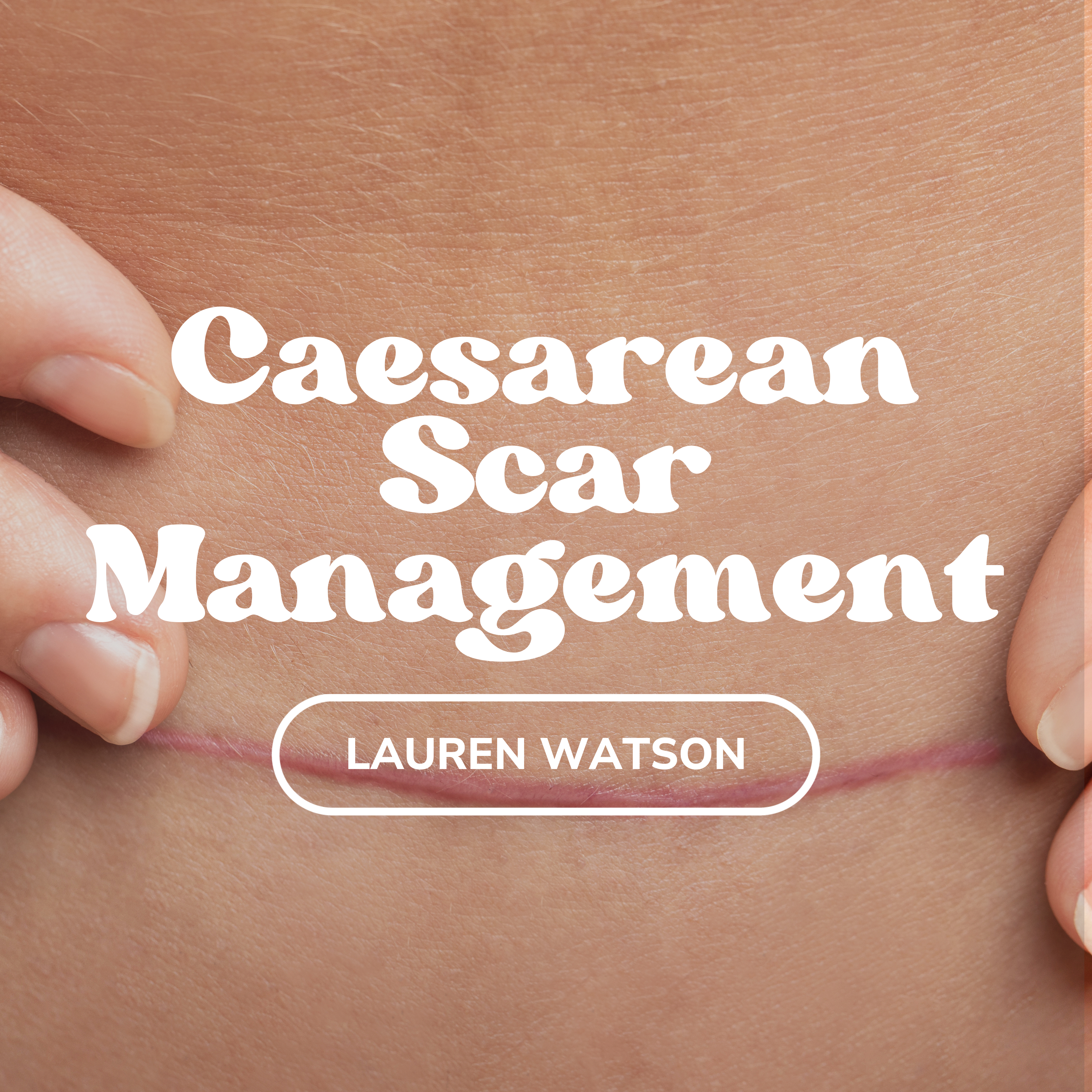 Caesarean Scar Management