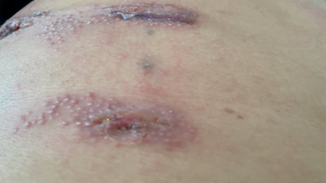 An Allergic reaction to the glue of t...