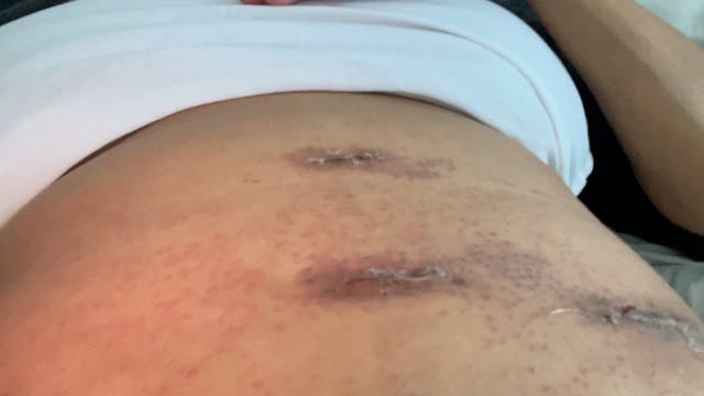 Allergic reaction after surgery