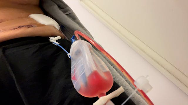 Lapband surgery sept 2022