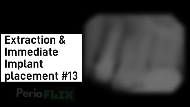 Extraction & Immediate Implant placem...