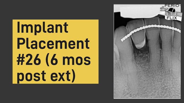 Implant placement #26